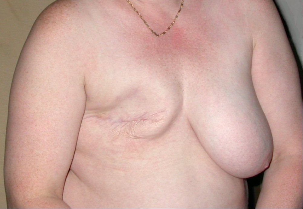 Mastectomie_02.jpg